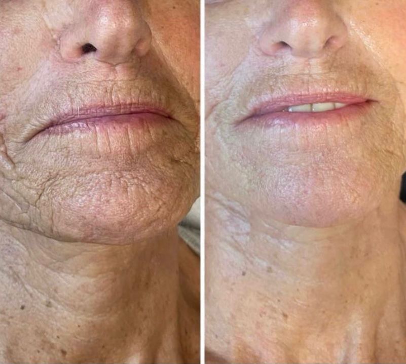 résultat soin anti-âge